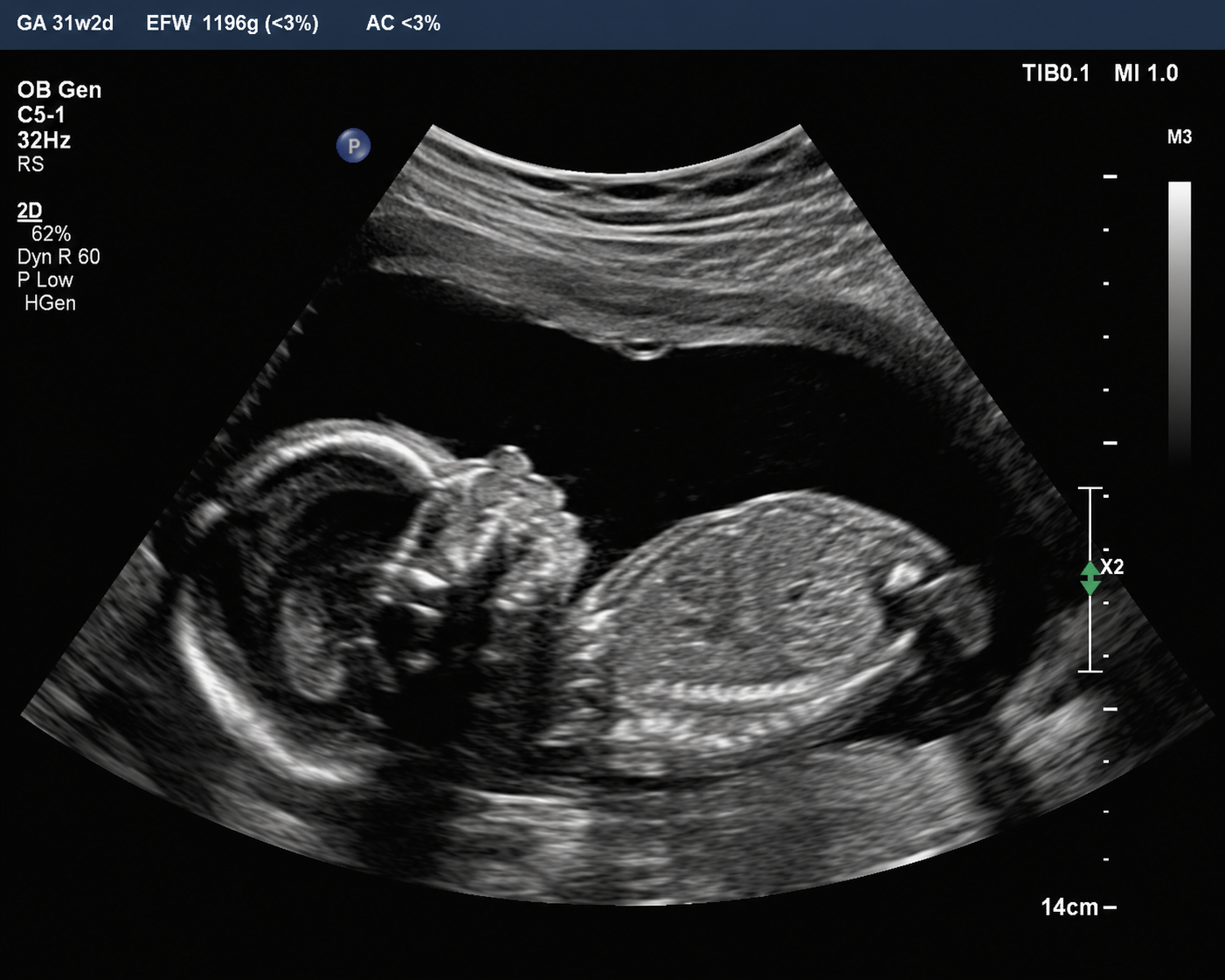 Fetal ultrasound biometric measurements for fetal growth restriction expert witness
